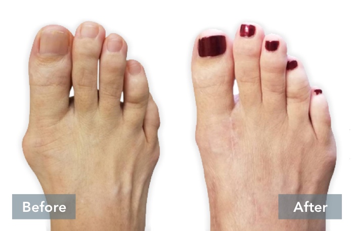 Before and After images of person's feet with dark red painted toenails, showing the difference in their foot before they received Lapiplasty® 3D Bunion Correction™ and their foot's appearance after the bunion has been corrected with Lapiplasty® 3D Bunion Correction™.
