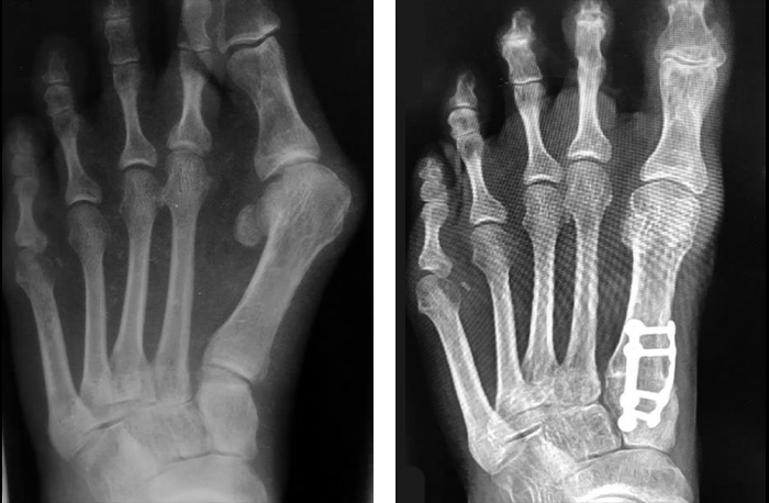 An image of X-rays of the same patient's foot before and after receiving Lapiplasty 3D Bunion Correction to treat a bunion on their foot.