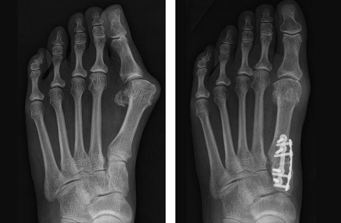 Side by X-Ray side images of a patient's foot, showing the appearance before and after Lapiplasty 3D bunion correction for a bunion, with the Lapiplasty insert clearly visible on the X-Ray.
