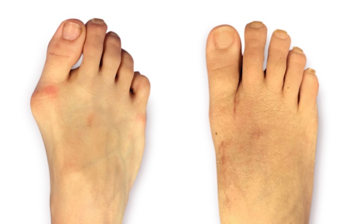 Side by side images of a light skinned patient's foot, showing the appearance before and after Lapiplasty 3D bunion correction. Image courtesy of JP McAleer, DPM