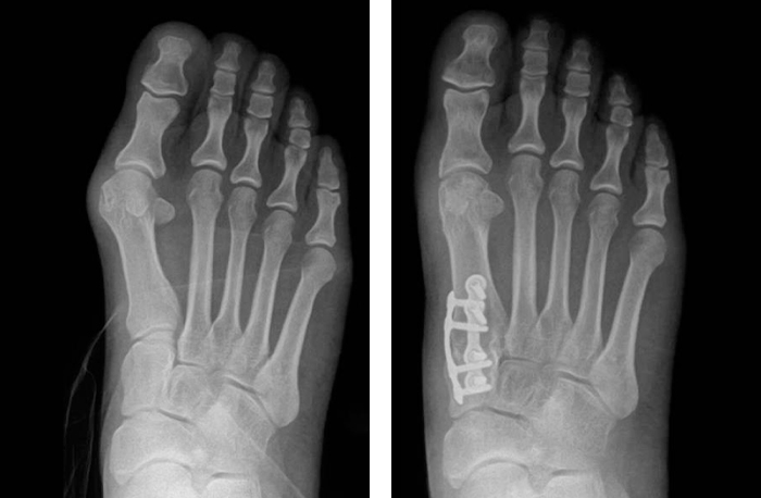 Side by X-Ray side images of a patient's foot, showing the positive impact of Lapiplasty 3D Bunion Correction for a patient who previously experienced bunion pain.