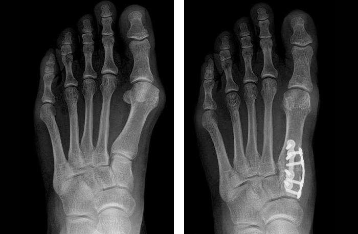 Side by X-Ray side images of a patient's right foot, showing the difference in appearance after a bunion has been corrected with the Lapiplasty procedure.