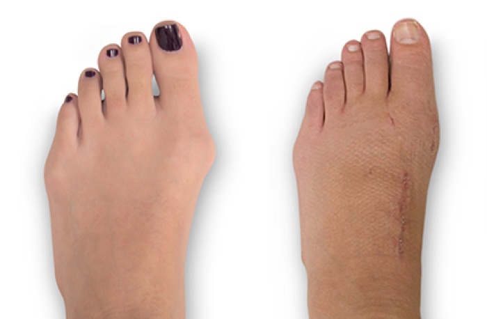 Side by side images of a patient's foot with dark red nail polish, showing the appearance before and after Lapiplasty 3D bunion correction. Image courtesy of JP McAleer, DPM