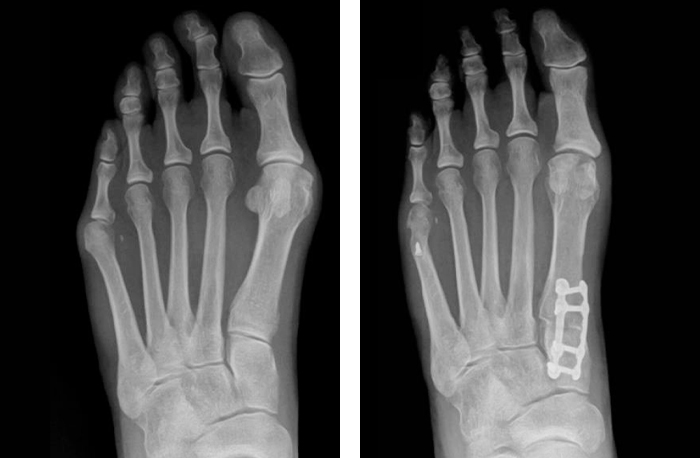 Side by X-Ray side images of a patient's right foot, showing the difference in appearance after a bunion has been corrected with the Lapiplasty procedure.