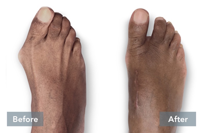 Before and After images of an African American person's feet, showing the difference in their foot before they received Lapiplasty® 3D Bunion Correction™ and their foot's appearance after the bunion has been corrected with Lapiplasty® 3D Bunion Correction™.