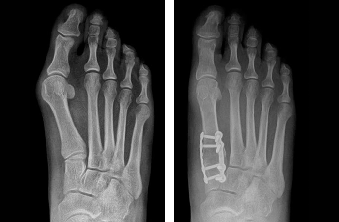 A six-month before and after X-Ray comparison of a Lapiplasty patient's right foot.