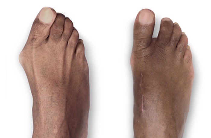 Side by side images of a brown skinned patient's foot, showing the appearance before and after Lapiplasty 3D bunion correction. Image courtesy of JP McAleer, DPM