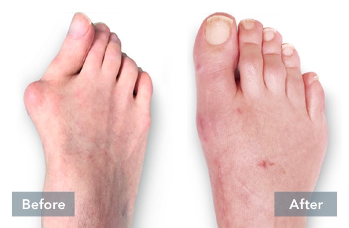 Before and After images of person's feet with a severe bunion, showing the difference in their foot before they received Lapiplasty® 3D Bunion Correction™ and their foot's appearance after the bunion has been corrected with Lapiplasty® 3D Bunion Correction™.