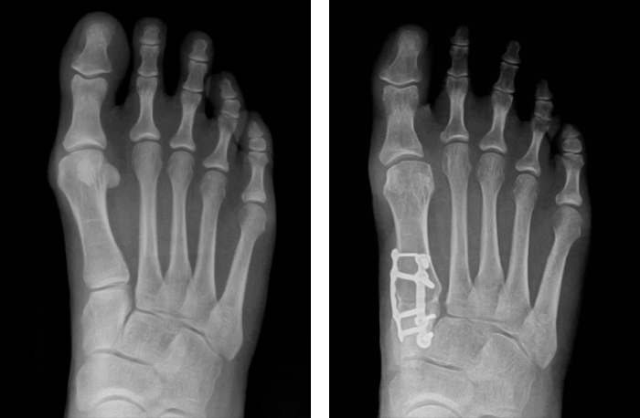 Two side-by-side before and after X-rays of a patient's foot showing the progress of bunion correction offered by Lapiplasty 3d Bunion Correction.