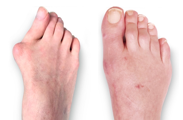 Side by side images of a light skinned patient's foot, showing the appearance before and after Lapiplasty 3D bunion correction for a severe bunion. Image courtesy of JP McAleer, DPM