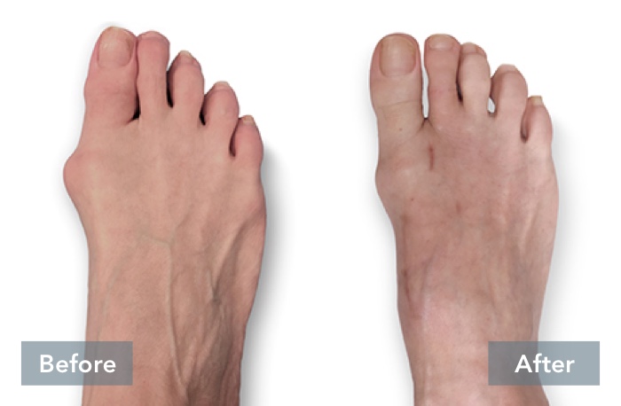 Before and After images of person's feet, showing the difference in their foot before they received Lapiplasty® 3D Bunion Correction™ and their foot's appearance after the bunion has been corrected with Lapiplasty® 3D Bunion Correction™.