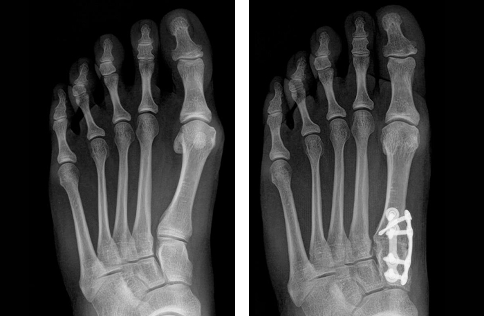 X-ray before and after image of the left foot of a patient who has had their bunion corrected in three dimensions through the Lapiplasty procedure.
