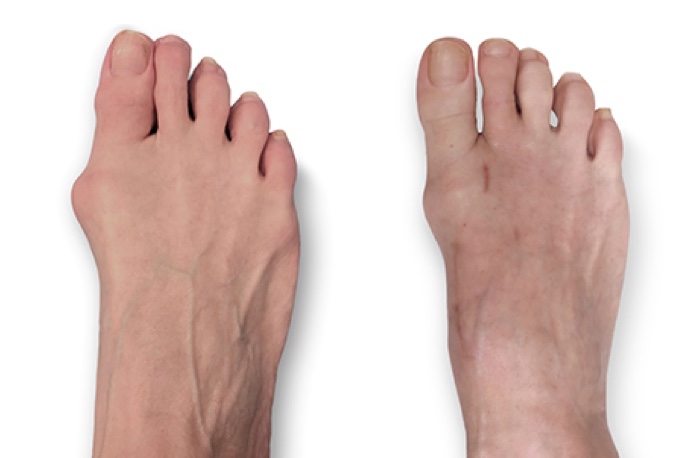 Side by side images of a light skinned patient's foot, showing the appearance before and after Lapiplasty 3D bunion correction for a moderate bunion. Image courtesy of JP McAleer, DPM