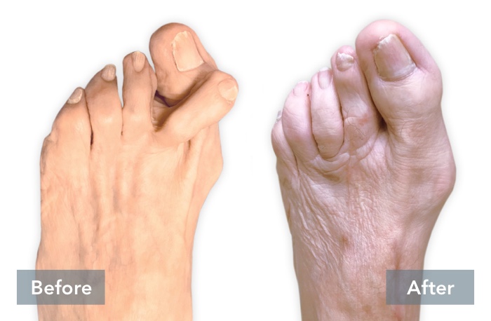 Before and After images of person's feet who has a severe bunion where the second toe is crossed over the big toe, showing the difference in their foot before they received Lapiplasty® 3D Bunion Correction™ and their foot's appearance after the bunion has been corrected with Lapiplasty® 3D Bunion Correction™.