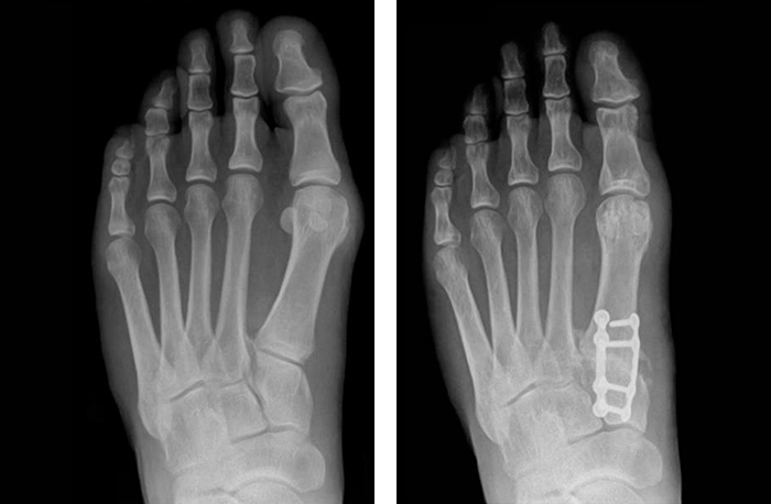 A demonstrative before and after of X-ray images from a Lapiplasty patient, showing the extent of 3D Bunion Correction.