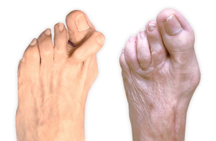 Side by side images of a light skinned patient's foot, showing the appearance before and after Lapiplasty 3D bunion correction for a severe bunion with the second toe crossed over the big toe before correction. Image courtesy of JP McAleer, DPM