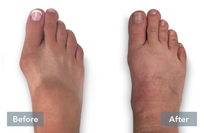 Before and After images of person's tanned feet with sandal lines, showing the difference in their foot before they received Lapiplasty® 3D Bunion Correction™ and their foot's appearance after the bunion has been corrected with Lapiplasty® 3D Bunion Correction™.