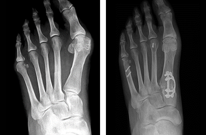 An image of X-rays from a Lapiplasty patient's foot, showing how their bunion has been corrected with Lapiplasty 3D Bunion Correction.