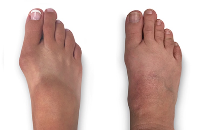 Side by side images of a patient's foot, showing the appearance before and after Lapiplasty 3D bunion correction for a moderate bunion. Image courtesy of JP McAleer, DPM