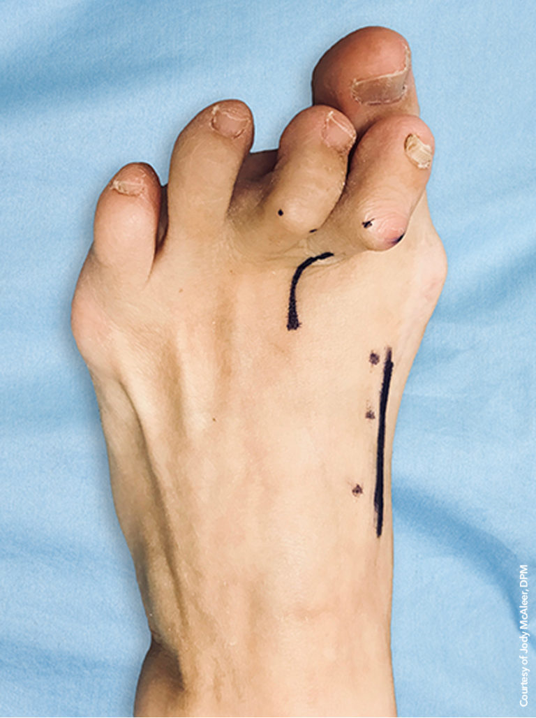 Will A Bunion Go Away? Treace