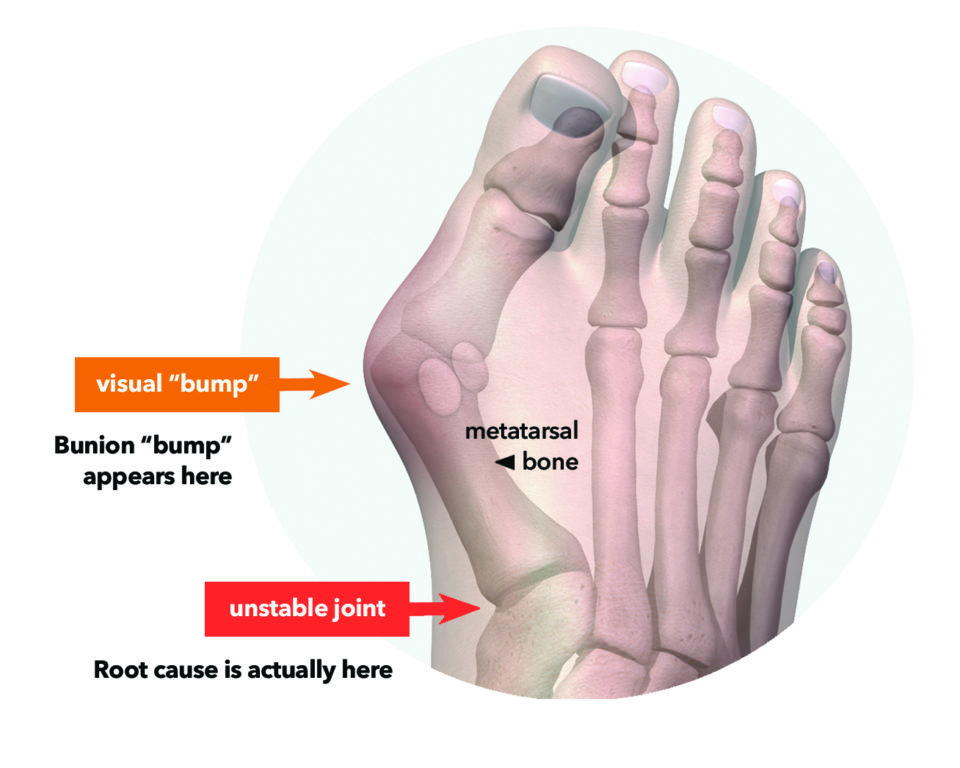 What is a Bunion? Hallux Valgus Treace Medical Concepts, Inc.
