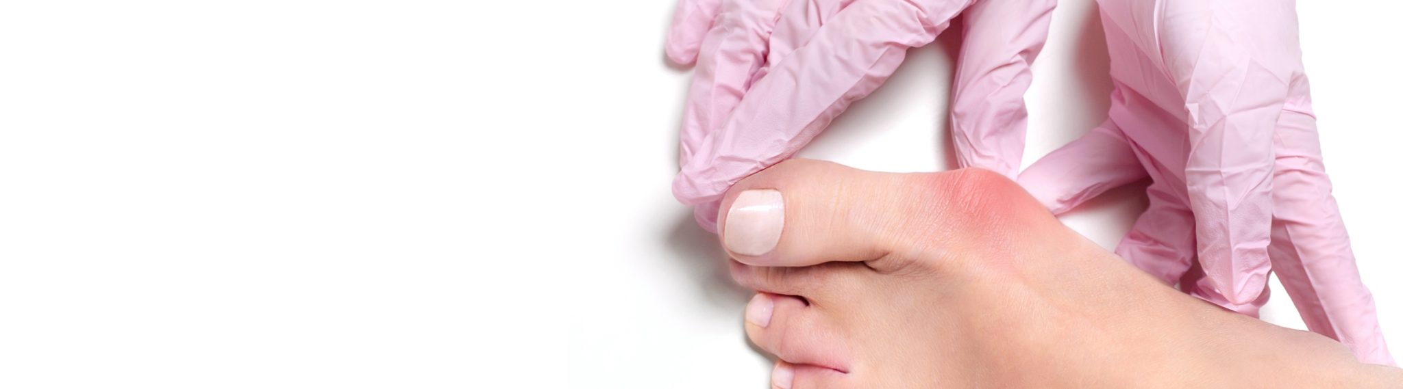 6 easy exercises to relieve bunion pain Treace