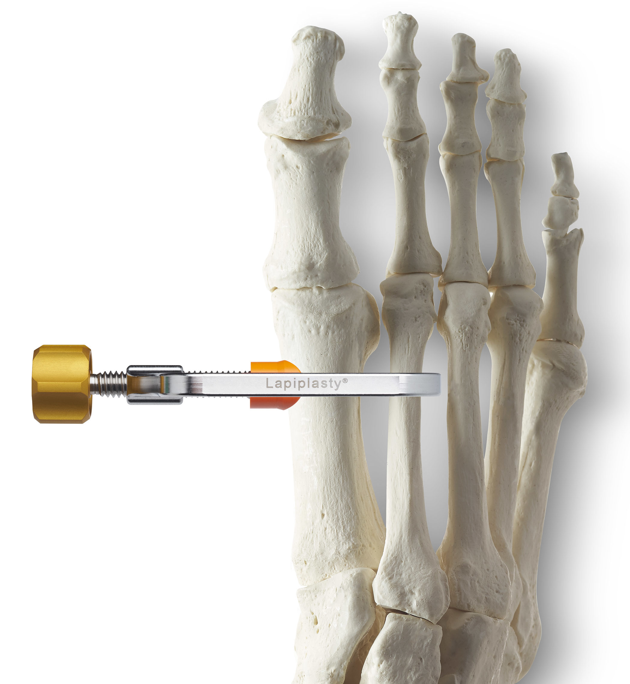 MTP Arthrodesis Key Steps And Fluoro Checks Treace Medical Concepts Inc 