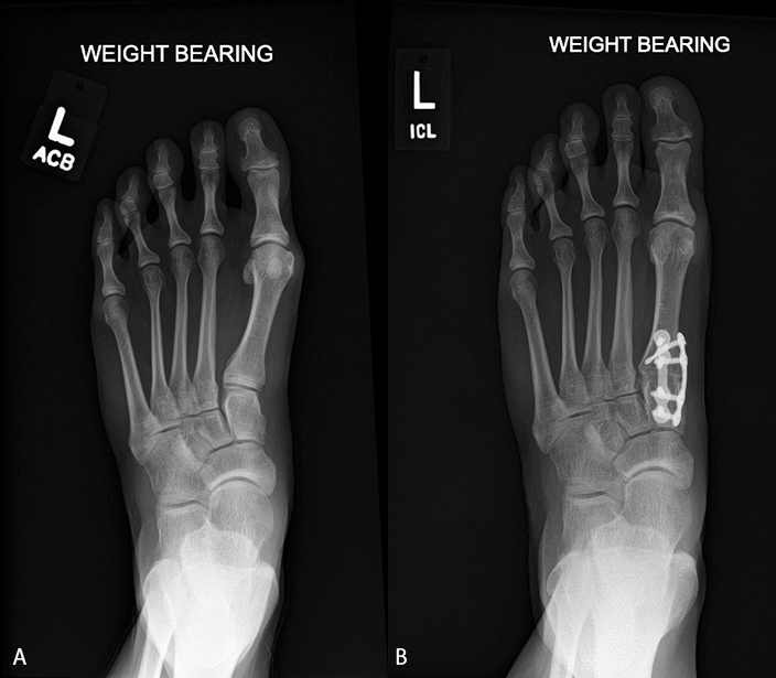 Treatment of Hallux Valgus Deformity Benefits from 3D ‘Revolution’ Treace