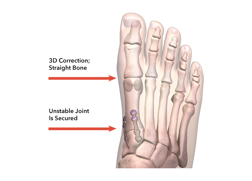 An illustration showing the appearance of a foot that has had a bunion corrected in three dimension with Lapiplasty 3D Bunion Correction, including the unstable joint being secured for bunion correction.