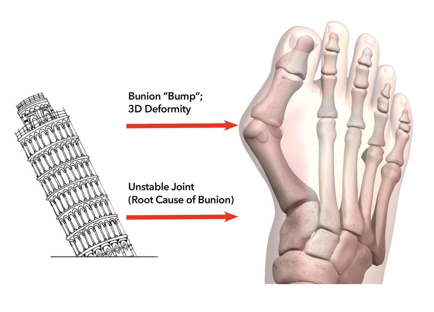 Lapiplasty® 3D Bunion Correction™ Treace Medical Concepts, Inc.