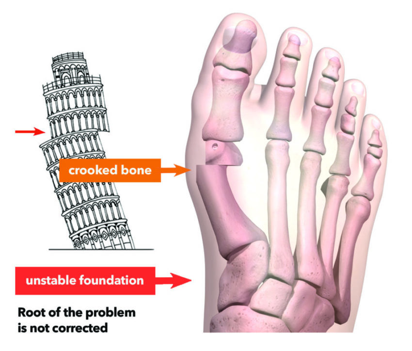 Image showing how a traditional 2D bunion correction surgery cuts and shifts unstable bones in the foot, addressing only the cosmetic bump without treating the underlying cause of the unstable joint. Uses an image of a cut and shifted Leaning Tower of Pisa as an illustration.