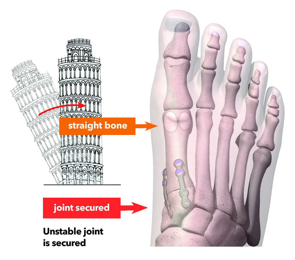 Image showing how the Lapiplasty® 3D Bunion Correction™ procedure re-aligns unstable joints in the foot to correct a bunion, using an image of a straightened Leaning Tower of Pisa as an illustration.