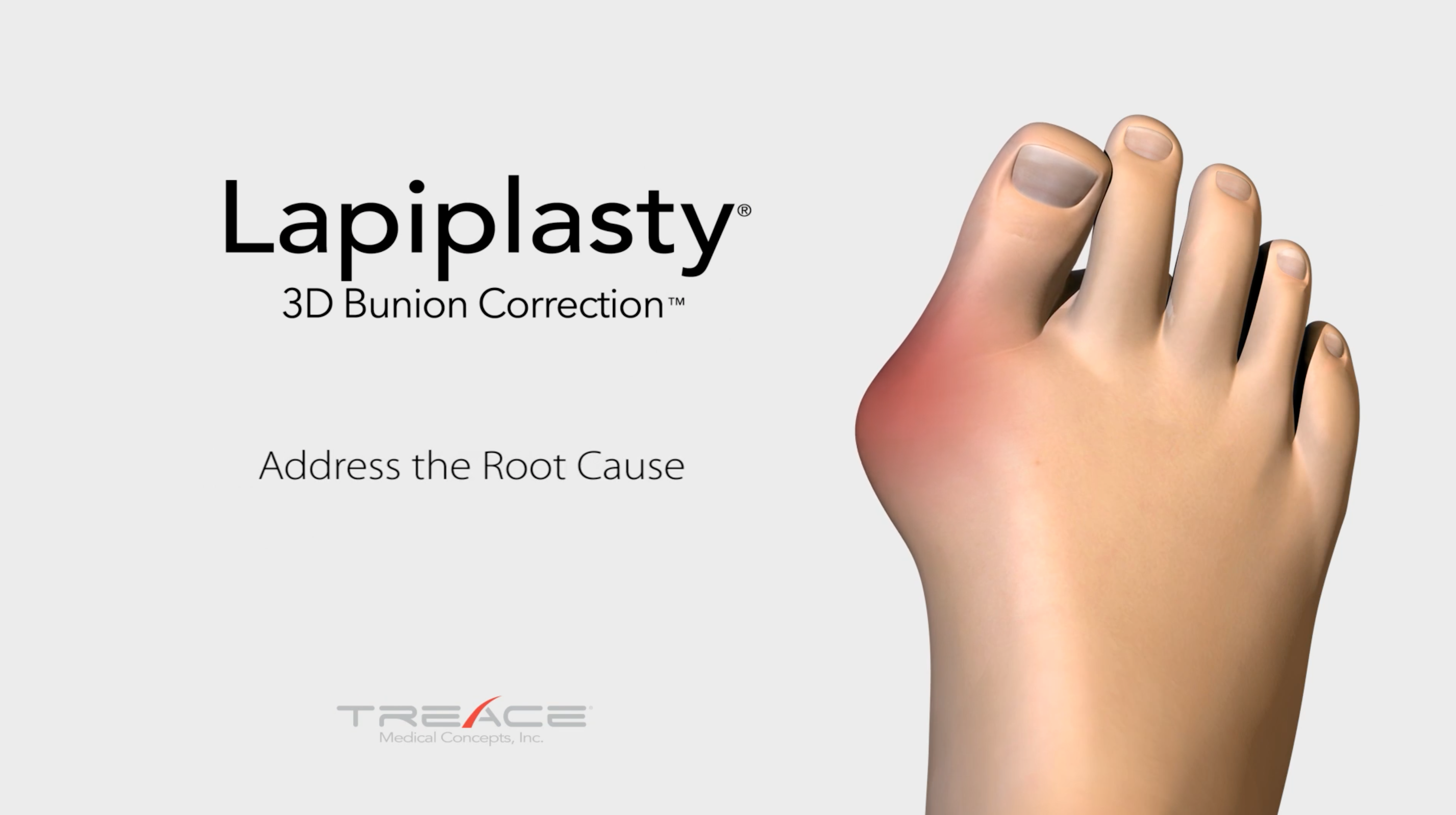 Lapiplasty<sup>®</sup> Procedure<br/> Educational Video