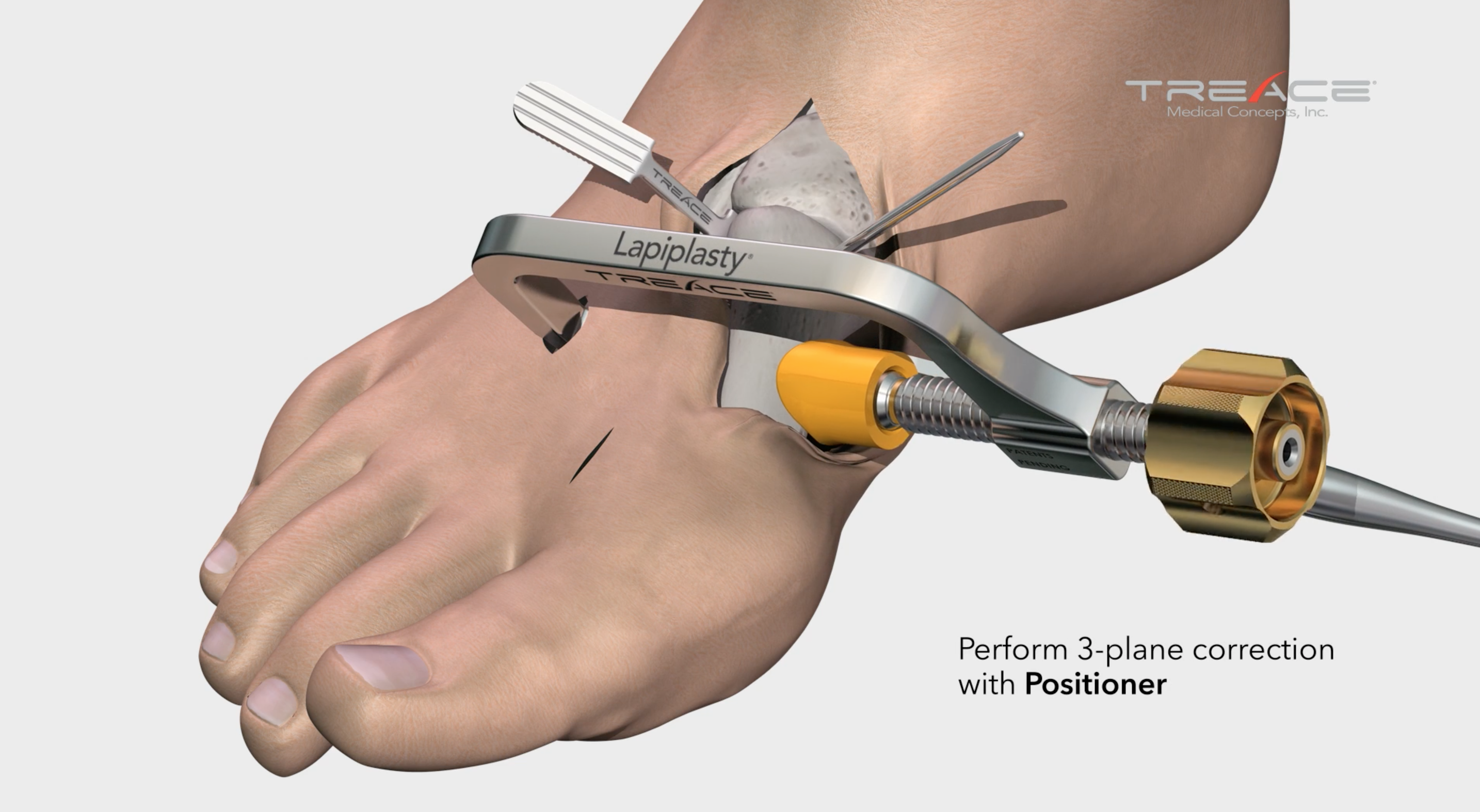 Lapiplasty<sup>®</sup> Surgical<br/> Technique Animation