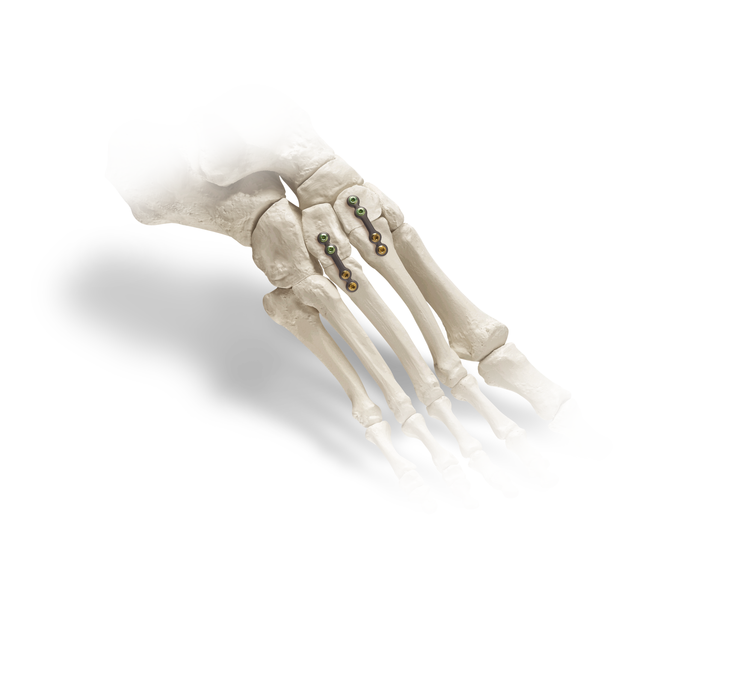 Adductoplasty® System Treace