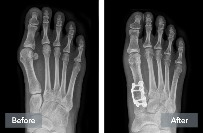 Side by X-Ray side images of a patient's right foot, showing the appearance before and after Lapiplasty 3D bunion correction for a bunion, with the Lapiplasty insert clearly visible on the X-Ray.