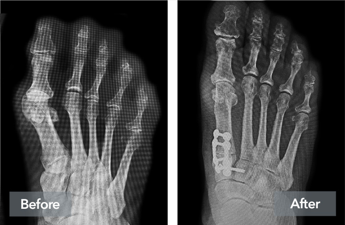 Lapiplasty® Before & After | Lapiplasty® 3D Bunion Correction™