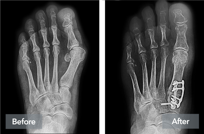 A before and after X-ray image from the same Lapiplasty patient, showing how Lapiplasty has helped correct their bunion in three dimensions.