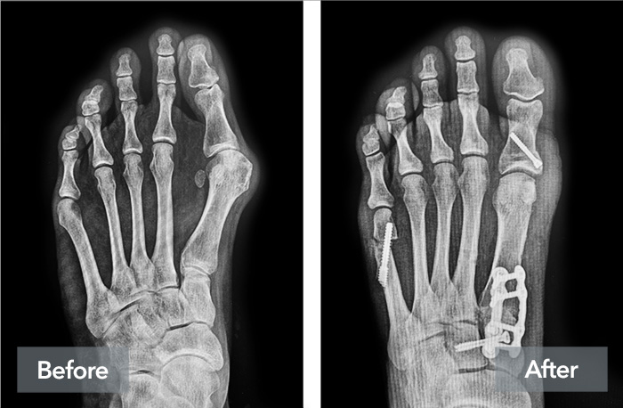 An image of the same patient's foot x-rays before and after the Lapiplasty 3D Bunion Correction treatment.