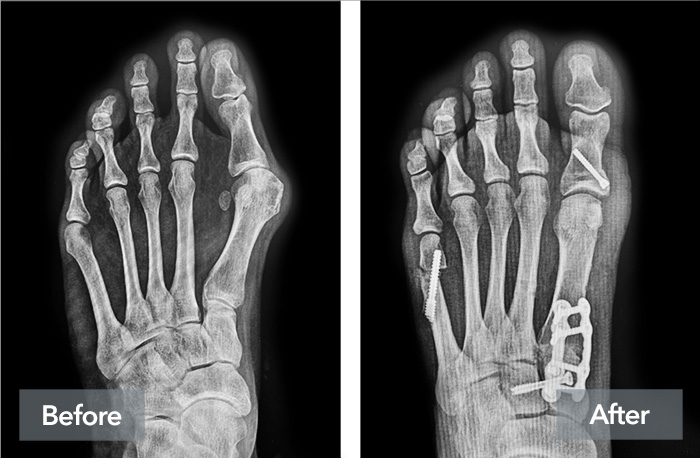 Lapiplasty® Before & After | Lapiplasty® 3D Bunion Correction™