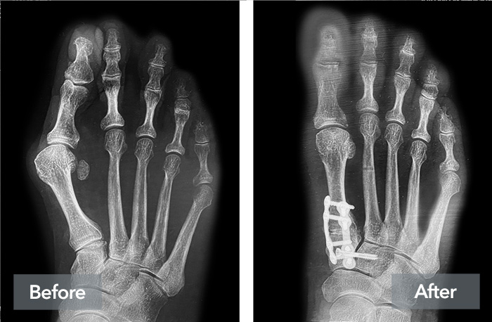 Before and after image using X-rays to show how Lapiplasty 3D Bunion Correction can correct a bunion by stabilizing the unstable joint.