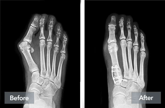 A demonstration of the results of Lapiplasty 3D Bunion Correction on a real patient, showing the X-rays of before and after the patient's treatment.