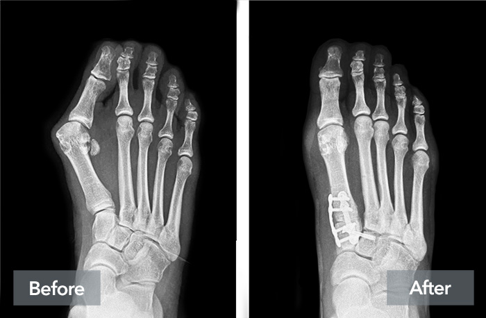 Lapiplasty® Before & After | Lapiplasty® 3D Bunion Correction™