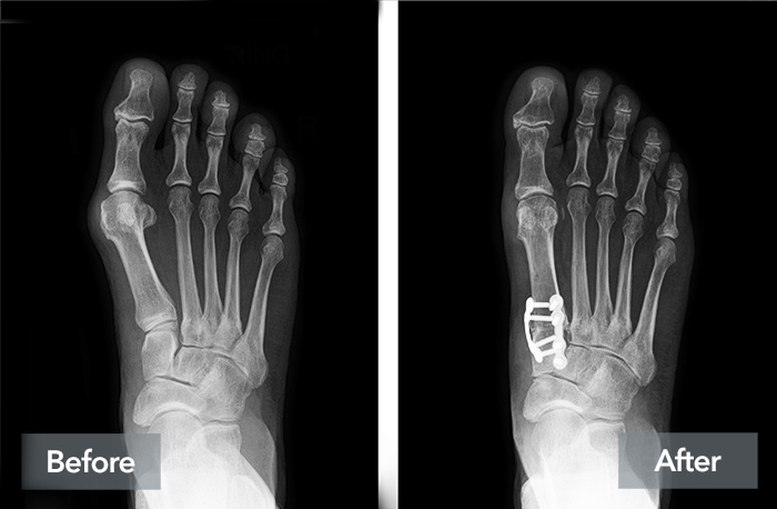 A before and after image of a patient's X-rays, showing improvement after bunion correction with Lapiplasty 3d Bunion Correction.
