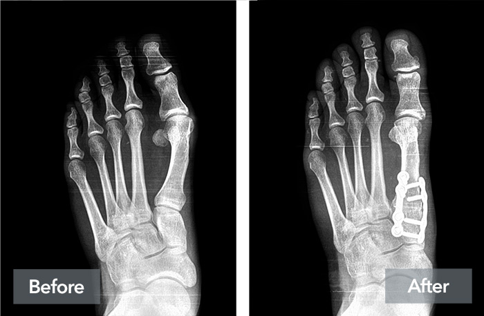 An image showing how the Lapiplasty 3D Bunion Correction procedure can help fix the root cause of bunions, shown through the same patient's before and after X-rays.