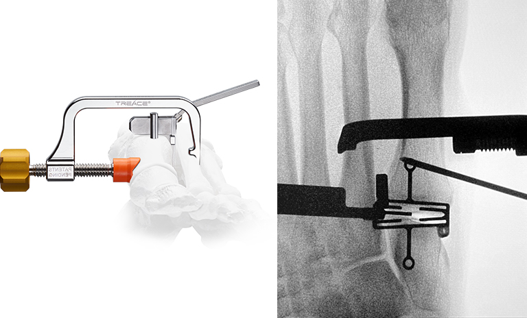 Illustration and X-Ray image showing step 1 of the Lapiplasty® 3D Bunion Correction™ procedure, where a surgeon uses the Lapiplasty® Positioner to quickly and reproducibly correct the alignment in all three planes, establishing and holding true anatomic alignment of the metatarsal and sesamoids.