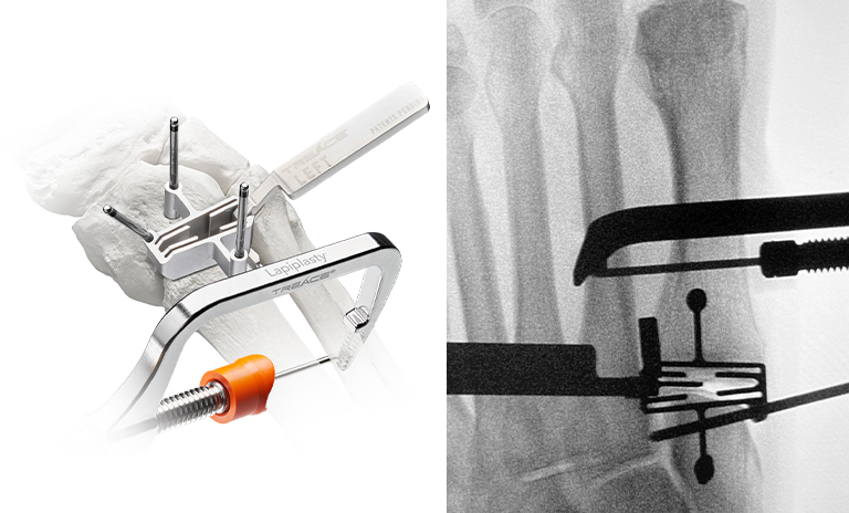 Illustration and X-Ray image showing step 2 of the Lapiplasty® 3D Bunion Correction™ procedure, where a surgeon uses the Lapiplasty® Cut Guide to deliver precise cuts with the metatarsal held in the corrected positions, ensuring optimal cut trajectory with only 2.4-3.1mm average metatarsal shortening.