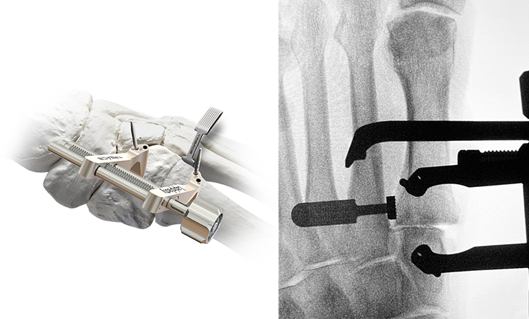 Illustration and X-Ray image showing step 3 of the Lapiplasty® 3D Bunion Correction™ procedure, where a surgeon uses the Lapiplasty® Compressor to deliver over 150N of controlled compression to the precision-cut joint surfaces while maintaining the 3-plane correction.