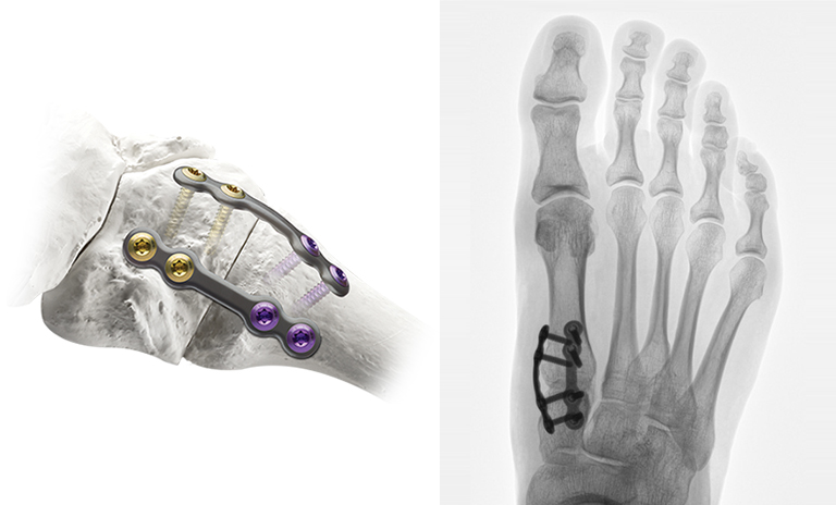Illustration and X-Ray image showing step 4 of the Lapiplasty® 3D Bunion Correction™ procedure, where a surgeon uses Low-profile Biplanar™ Plating to provide biomechanically-tested multiplanar stability for rapid return to weight-bearing in a boot.