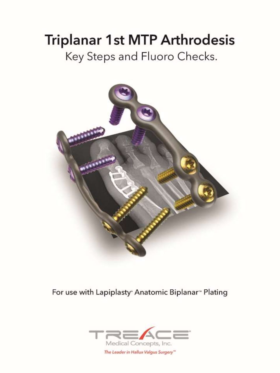 Triplanar 1st MTP Arthrodesis: Key Steps and Fluoro Checks